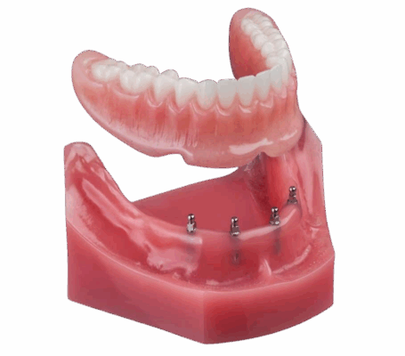 Implantes All-On-4 Dentaduras postizas sobre implantes en Southfield, Míchigan
