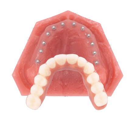 Implantes dentales de arco completo en Southfield, Míchigan | Puente Roundhouse Soluciones para la pérdida total de dientes