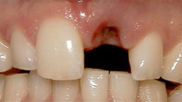 El paciente necesita un reemplazo de un solo diente, concretamente un incisivo central superior.