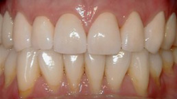 Sonrisa y función restauradas con un implante único y una corona (funda) totalmente de porcelana que se ajusta de manera segura sobre el implante.