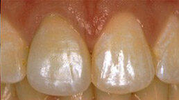 Sustituido por una corona totalmente de porcelana (sin metal). El diente ahora tiene un contorno que se adapta al resto de la línea de las encías. El diente restaurado tiene un aspecto muy natural y se adapta a la forma y el color de los dientes del paciente.