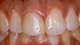 El diente central delantero (izquierdo) tiene una restauración deficiente. No tiene un aspecto natural y no está contorneado correctamente para adaptarse a la línea de las encías del resto de los dientes.