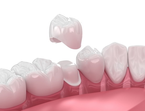 Same-Day Dental Crowns in Southfield, MI | Free Consultations