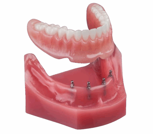 All-On-4 Implants Implant Dentures in Southfield, MI