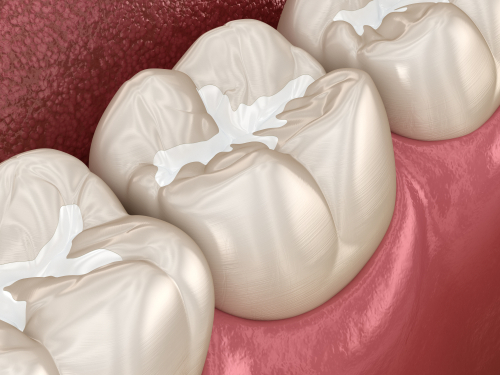 Composite Fillings Tooth-Colored Fillings in Detroit, MI 🦷