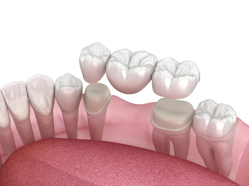 Dental Bridge in Southfield, MI | Book a Free Consultation