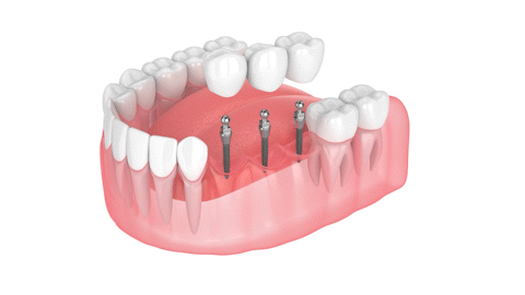Dental Bridge in Southfield, MI | Replace Teeth With Mini Implants