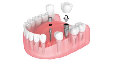 Dental Implants in Southfield, MI | Dental Implants vs. Mini Dental Implants