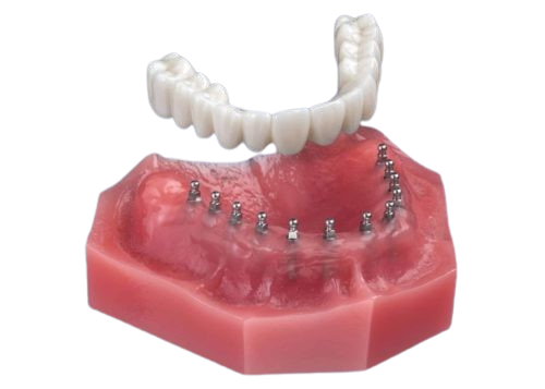 Dentures in Southfield, MI | Mini Implant Roundhouse Bridge | Aesthetic Dental