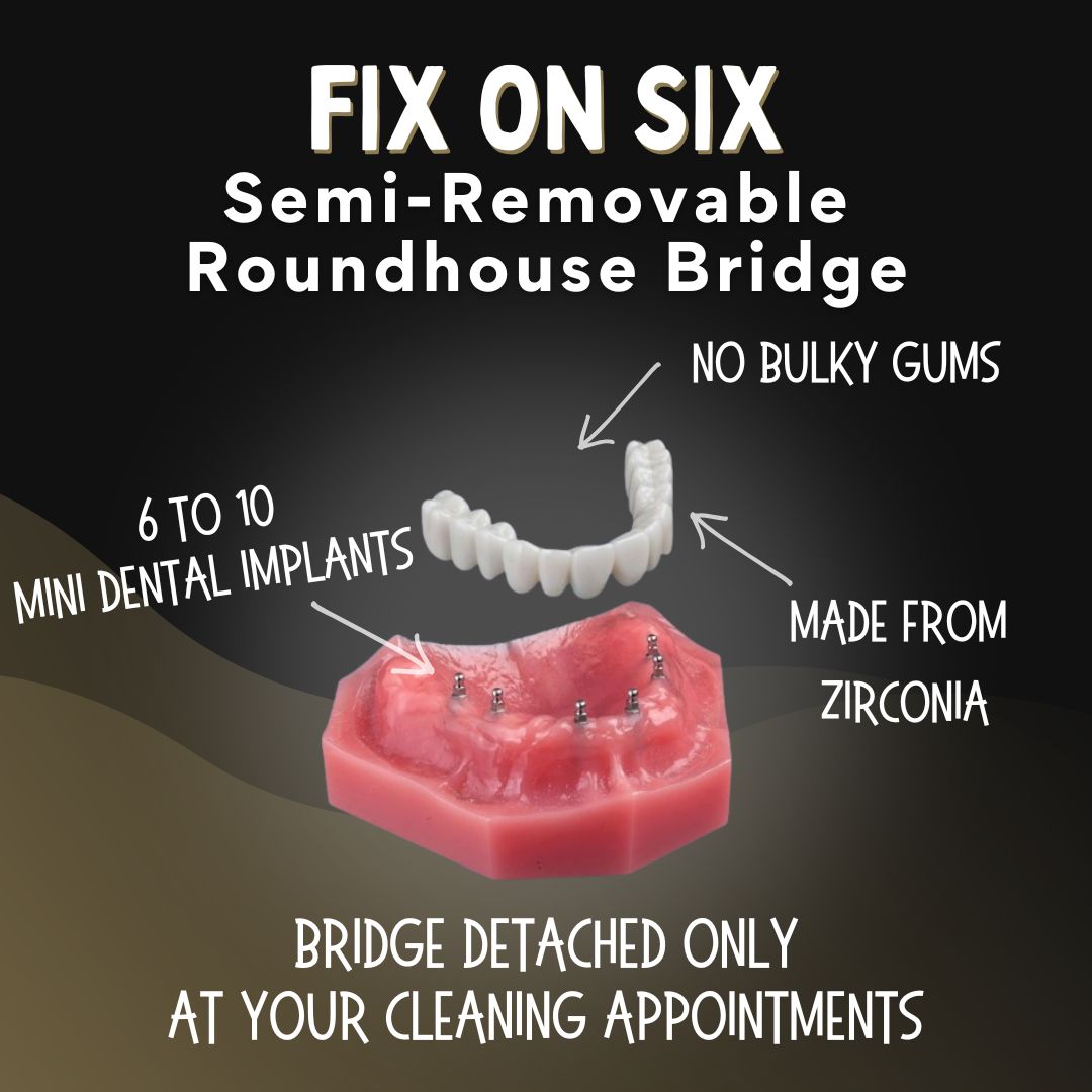 Fix on Six Implant Bridge in Southfield, MI