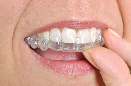 Alineadores transparentes Invisalign en Southfield, Míchigan Odontología estética