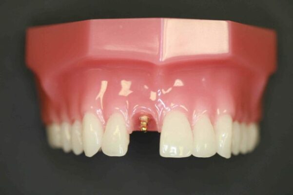 Implantes dentales asequibles en Southfield, Míchigan | Odontología estética