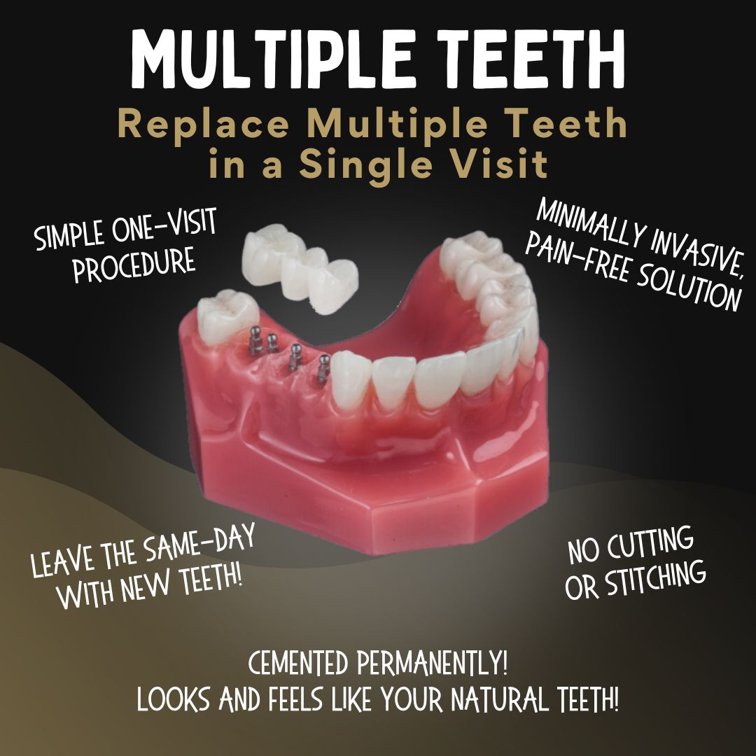 Multiple Tooth Replacement in Southfield, MI