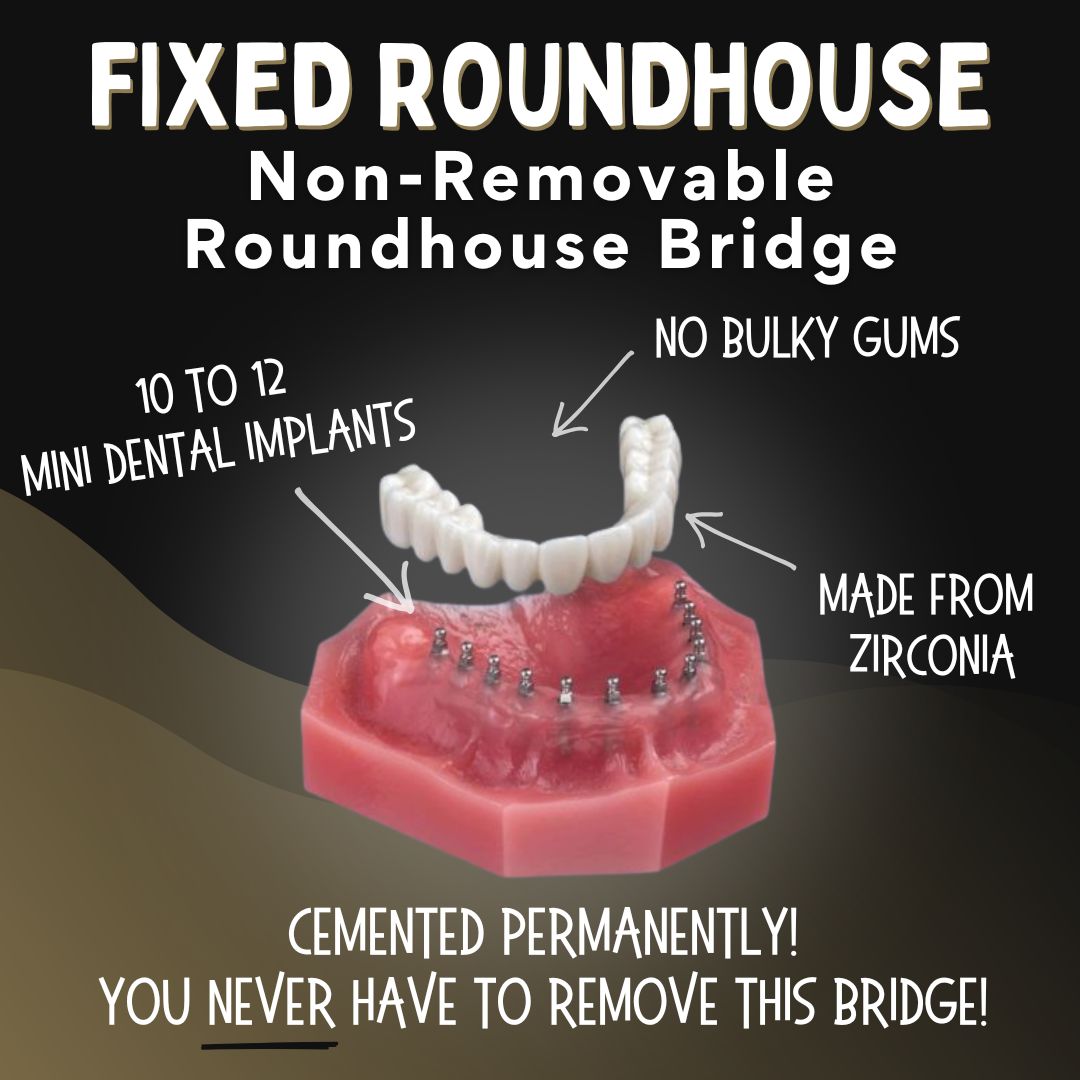 Roundhouse Fixed Implant Bridge in Southfield, MI
