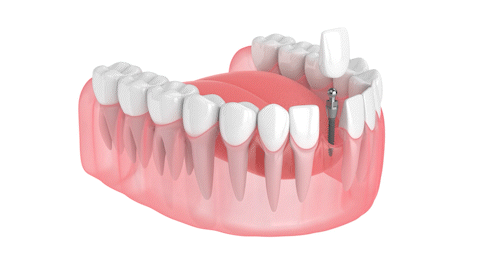 Same-Day Dental Crowns in Southfield, MI | Mini Implant-supported Dental Crowns