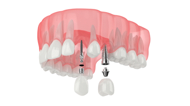 Same-Day Dental Implants in Southfield, MI | Experience Mini Dental Implants