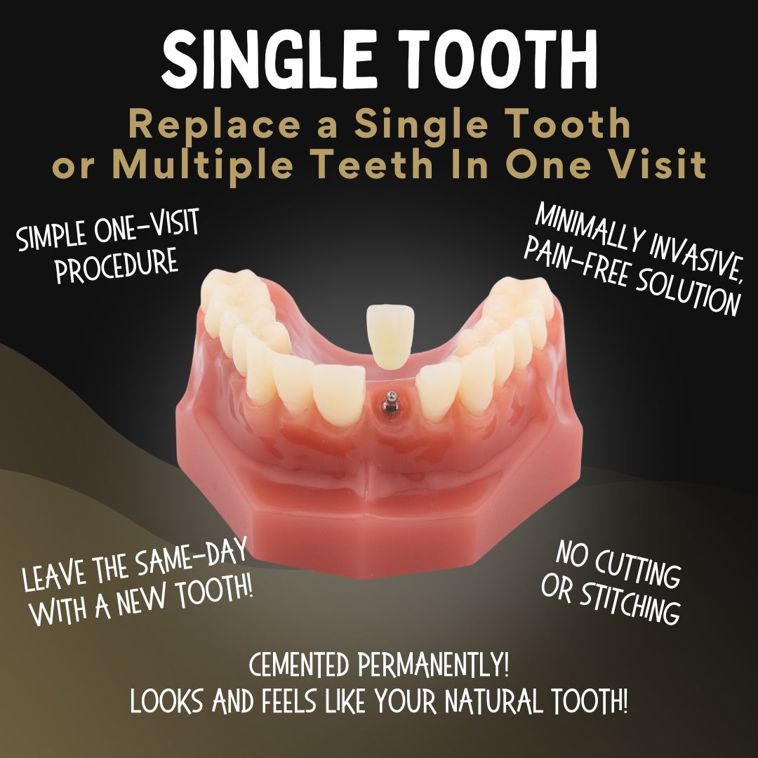 Single Tooth Replacement in Southfield, MI