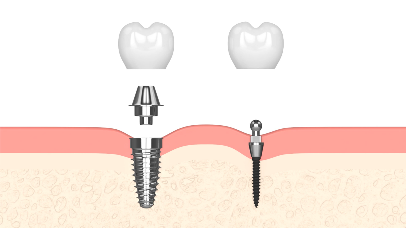Are Mini Dental Implants as Good as Regular Implants | Free Consultation in Southfield, MI
