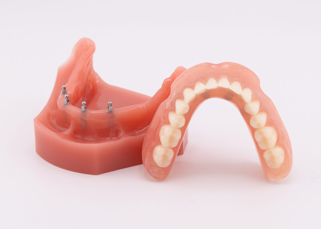 Mini Implant Dentures in Southfield, MI | Free Implant Consultations