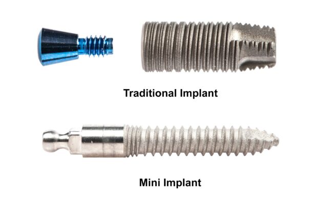 Best Implant Options in 2026 | Free Consultations in Southfield, MI