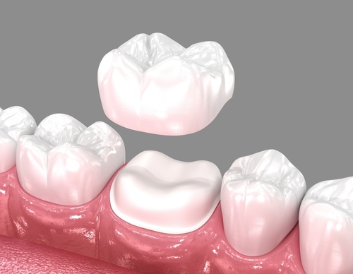 Veneers vs. Crowns in Southfield, MI Dental Crown Treatment