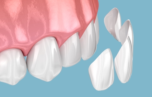 Veneers vs. Crowns in Southfield, MI | Porcelain Veneer Treatment