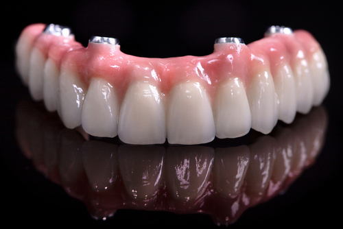 All-on-4 [Video Walkthrough] | Free Consultations in Southfield, MI