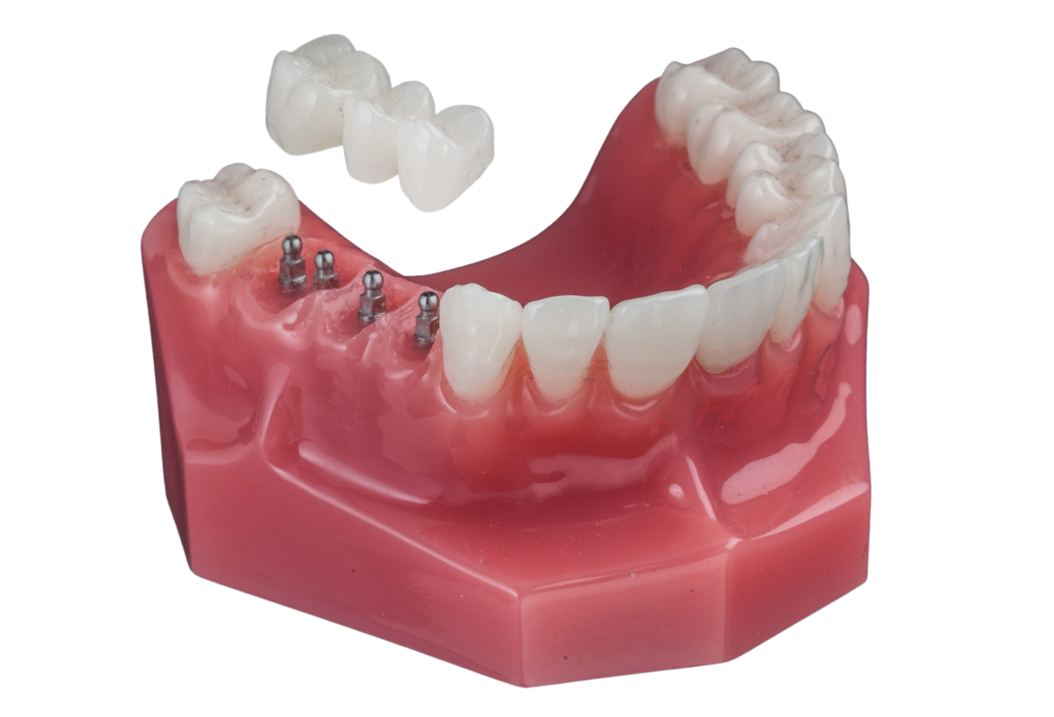 Implant Bridge [Video Explanation] Free Consultations in Southfield