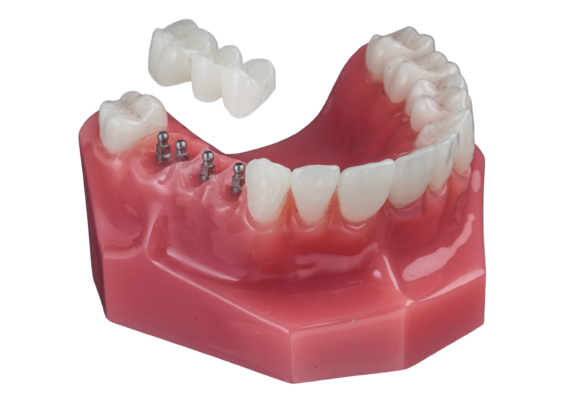 Implant Bridge [Video Explanation] Free Consultations in Southfield
