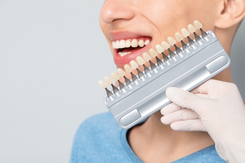 Smile Makeover in Southfield, MI | Dental Veneer Smile Transformation
