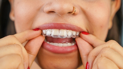 Clear Aligners vs. Braces in Southfield, MI | Free Consultations