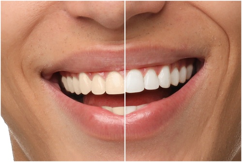 Best Teeth Whitening in Southfield, MI | Book a Free Consultation!