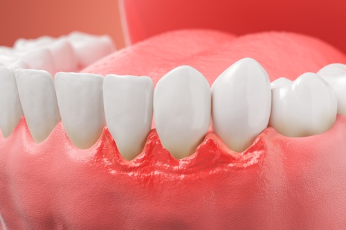 Bleeding Gums [Video Explanation] | Keep Your Smile Healthy
