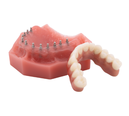 Alternativas a las dentaduras postizas en Southfield, MI | Puentes fijos tipo Roundhouse