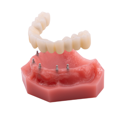 Alternativas a las dentaduras postizas en Southfield, MI | Asegura tu sonrisa con un puente Roundhouse