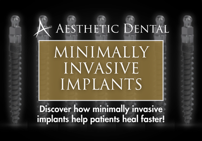 Minimally Invasive Dental Implants in Southfield, MI | Free Consults