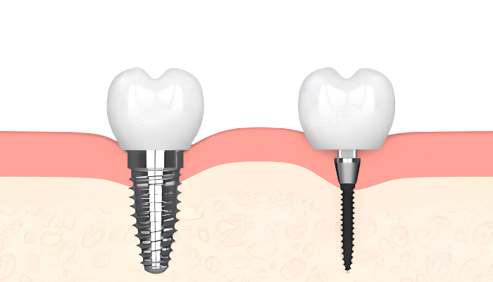 Dental Implants in Southfield, MI | Restore Your Smile With One-Piece Dental Implants