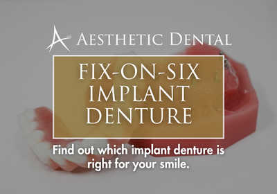 Fix-on-Six in Southfield, MI | Book a Free Implant Consultation