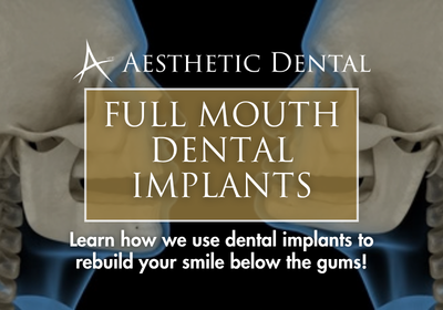 Full Mouth Dental Implants in Sterling Heights, MI | Free Consults